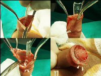 Plastibell circumcision