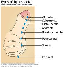 Degrees of hypospadias