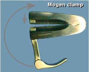 Mogen clamp