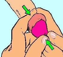 Treatment of paraphimosis