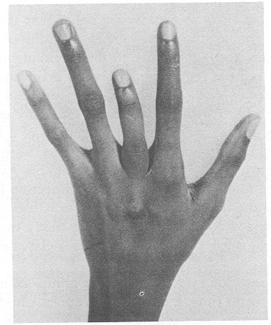 Finger shortened by sickle-cell trait