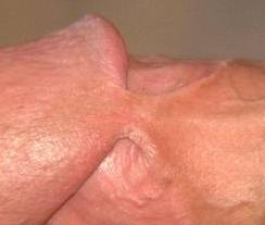 closeup of skin bridge 16