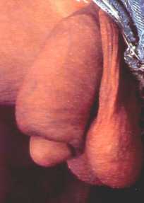 Scarring 4