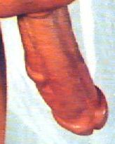 Vericose Veins Penis 61