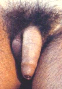 Man with cleft chin's penis