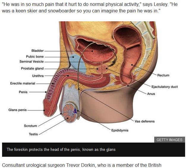 Getty image illustrating male anatomy in BBC story about suicide after genital cutting