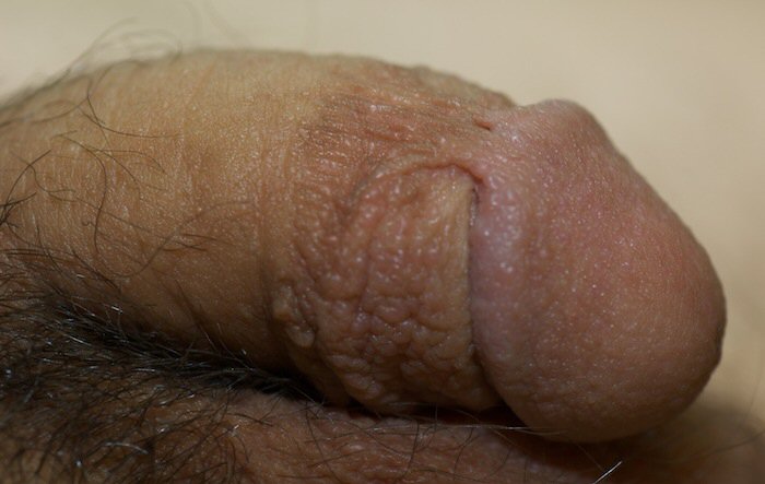 Image of penile skin adhesions.
