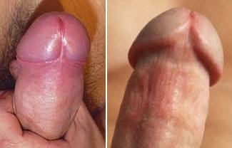 A Comparison of Intact and Circumcised Penises 