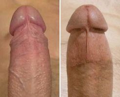 A Comparison of Intact and Circumcised Penises.