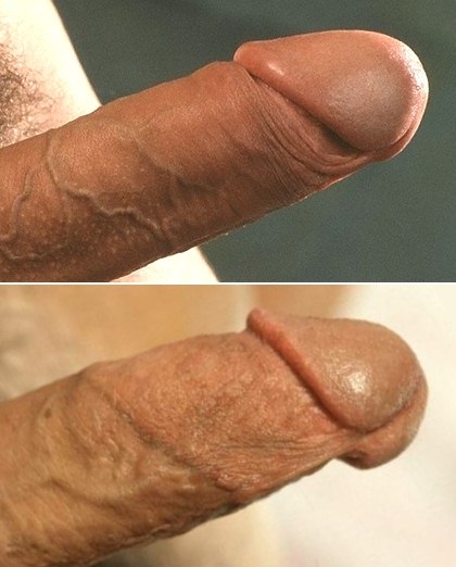 A Comparison of Intact and Circumcised Penises.